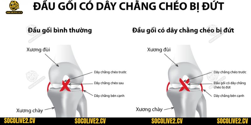 Chấn thương dây chằng chéo